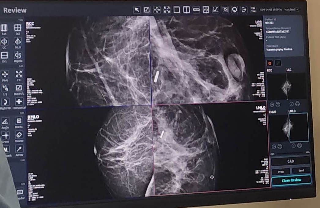 Mammogram test for breast cancer