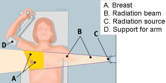 Kathmandu Cancer Center delivering hypofractionated radiotherapy for breast cancer