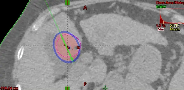 CT-guided liver tumour treatment at KCC — internal radiation guided by imaging