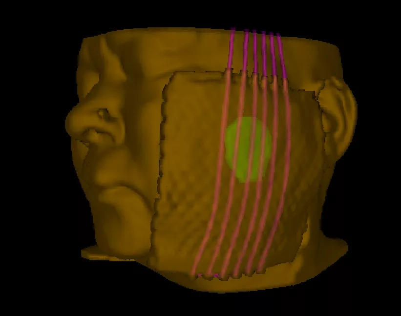 Skin cancer on the face treated without surgery using a custom mould at KCC Kathmandu