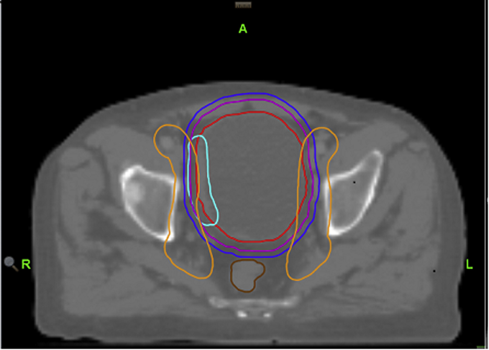 Radiotherapy planning for bladder preservation at Kathmandu Cancer Center