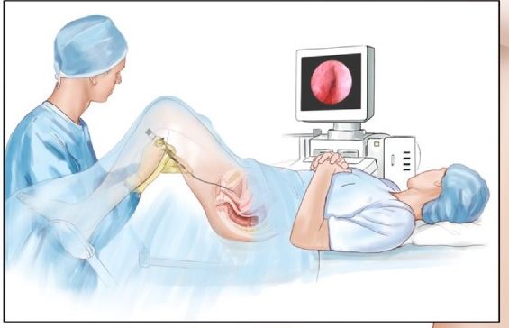 Cystoscopy procedure