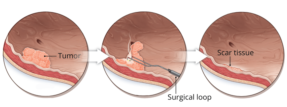 TURBT  procedure