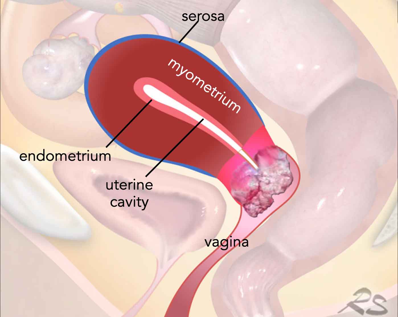Illustration of the cervix and where cervical cancer develops
