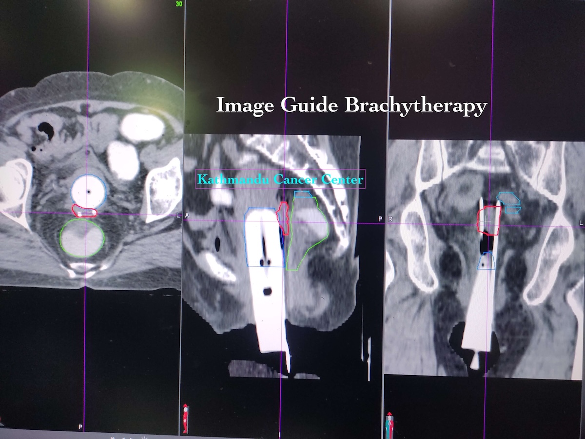 IGBT brachytherapy procedure at KCC — MRI-guided applicator placement