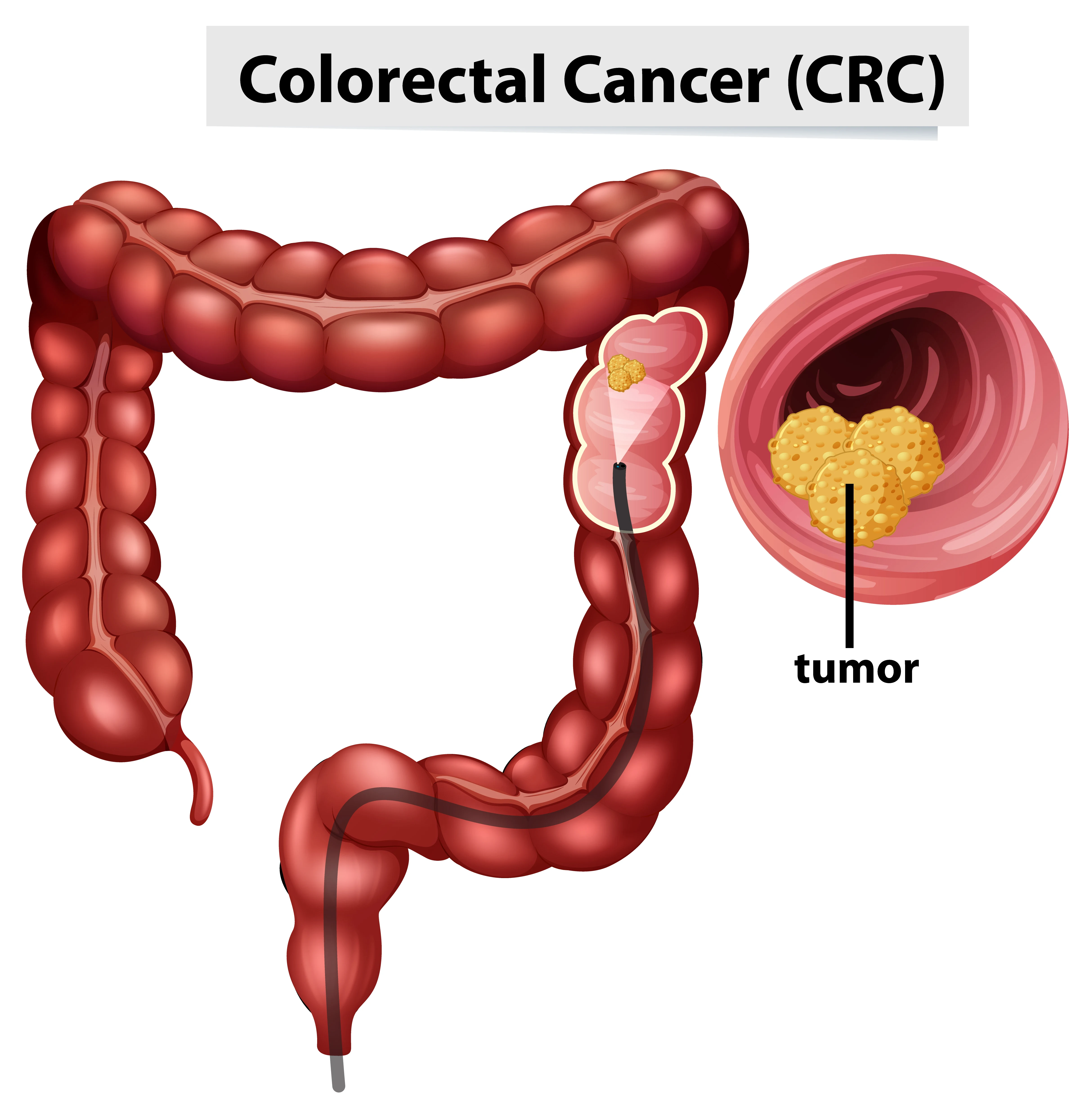 Colorectal cancer treatment at KCC Nepal