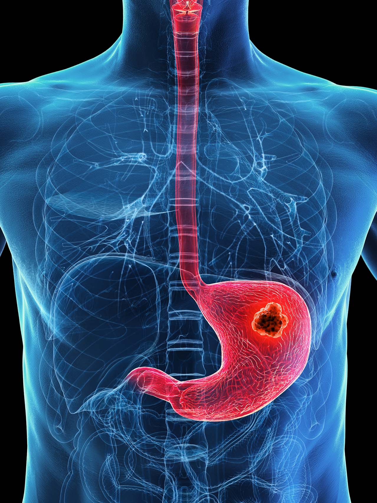 Stomach cancer treatment at KCC Nepal