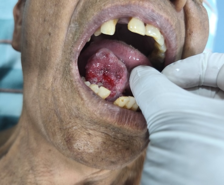 जिब्रोको क्यान्सरको सुरुको अवस्थाको Clinical तस्बिर