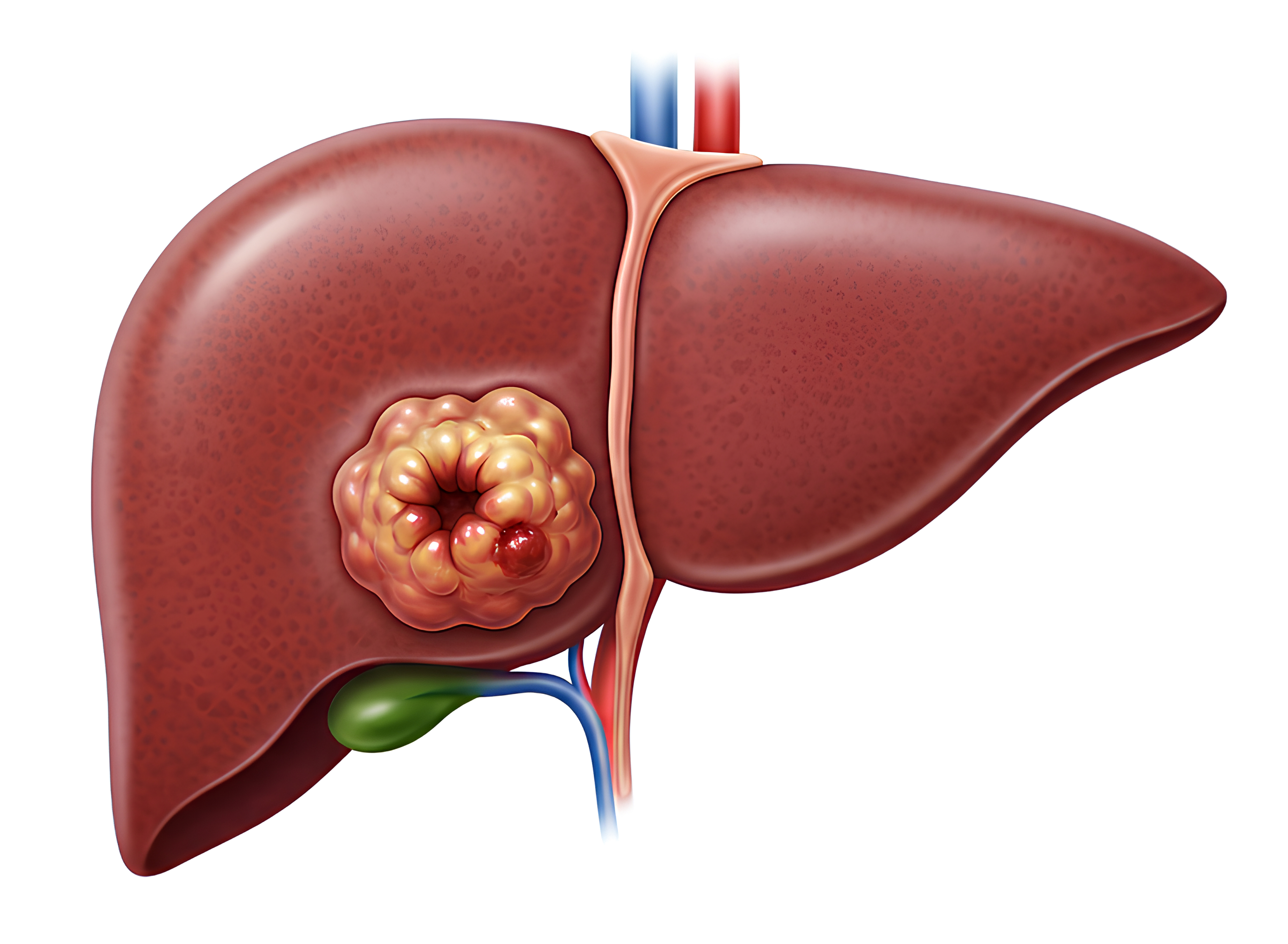 Liver Cancer 