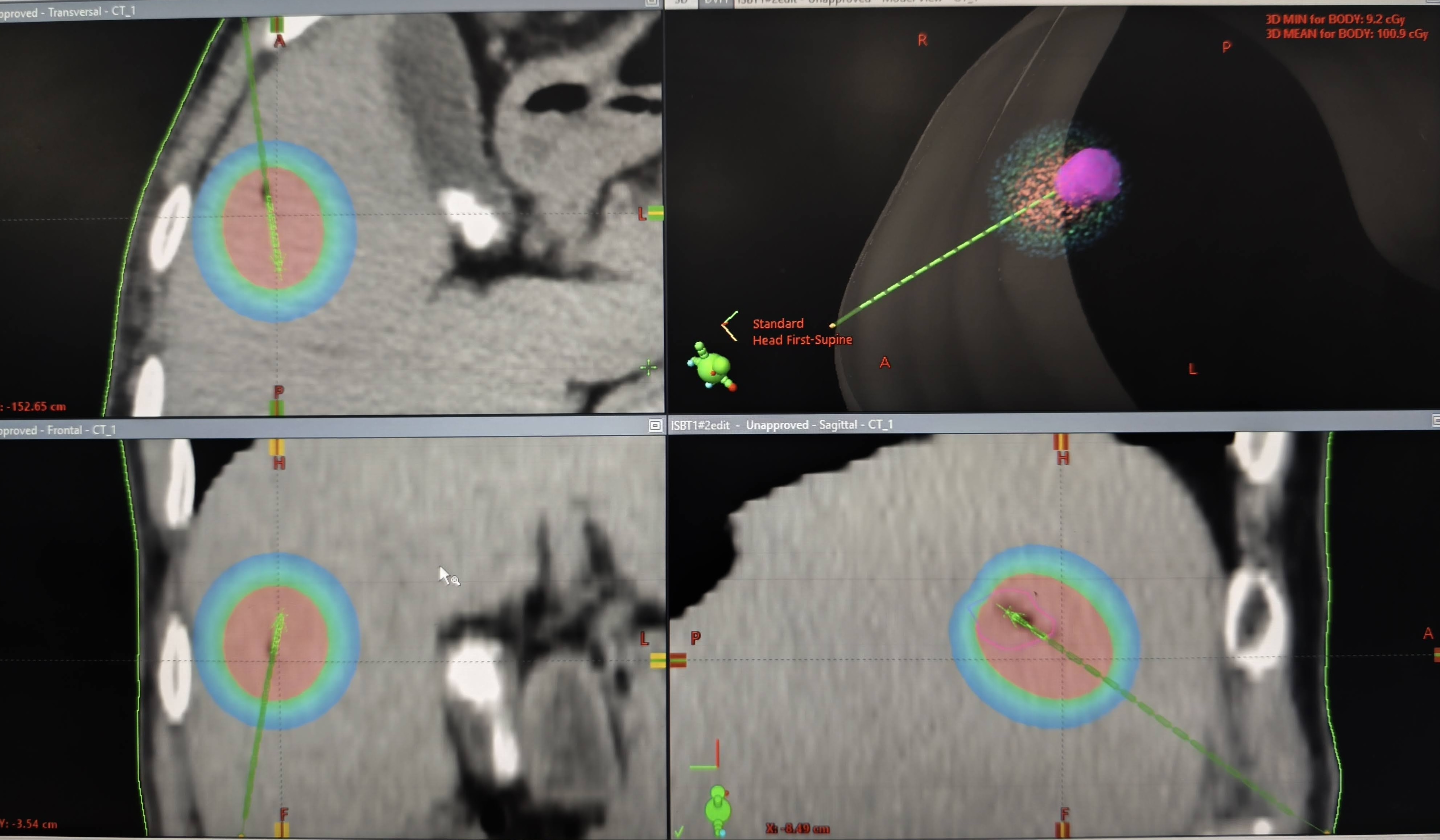 Internal radiotherapy (Brachytherapy) for liver cancer, only in KCC