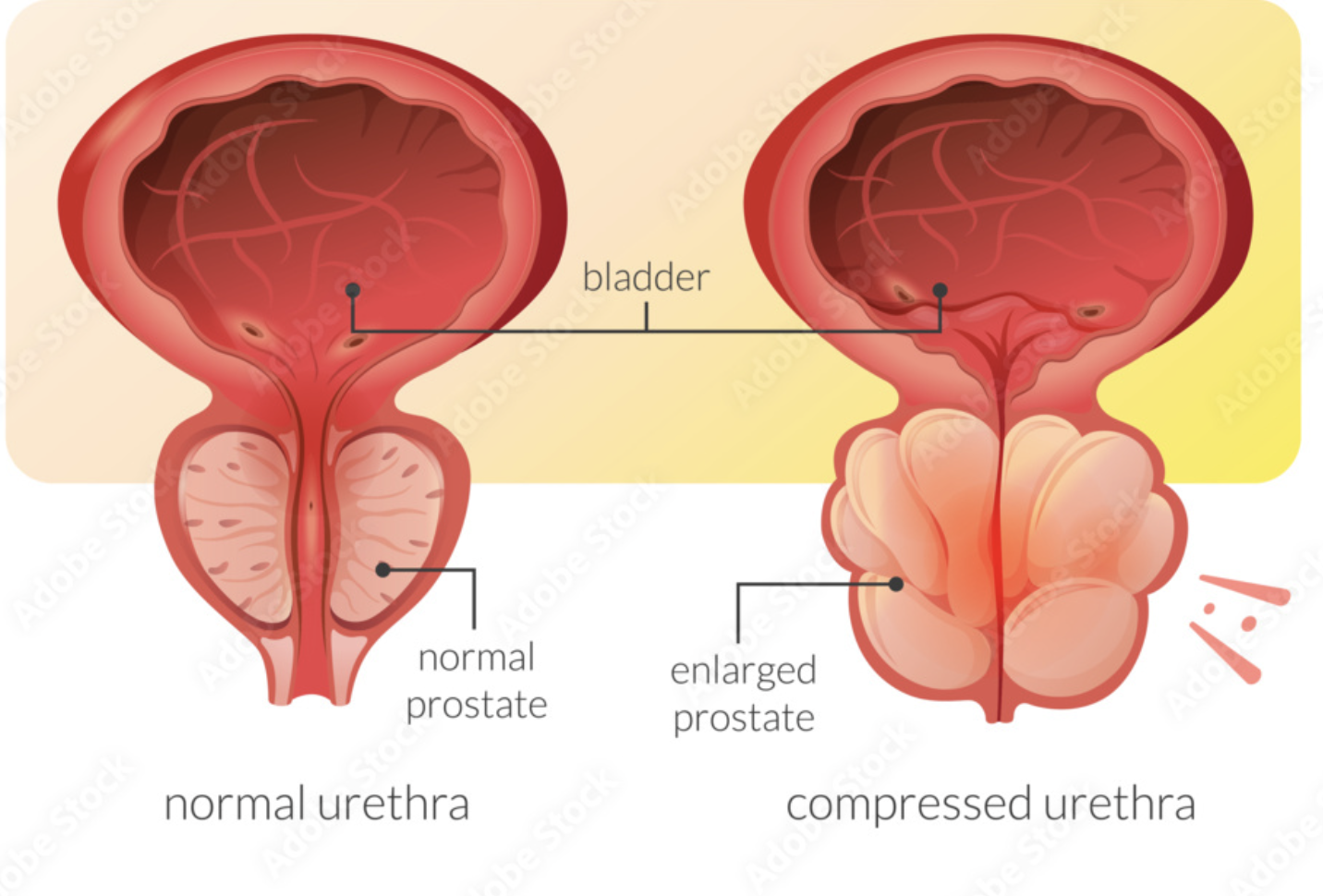 Prostate cancer treatment at KCC Nepal