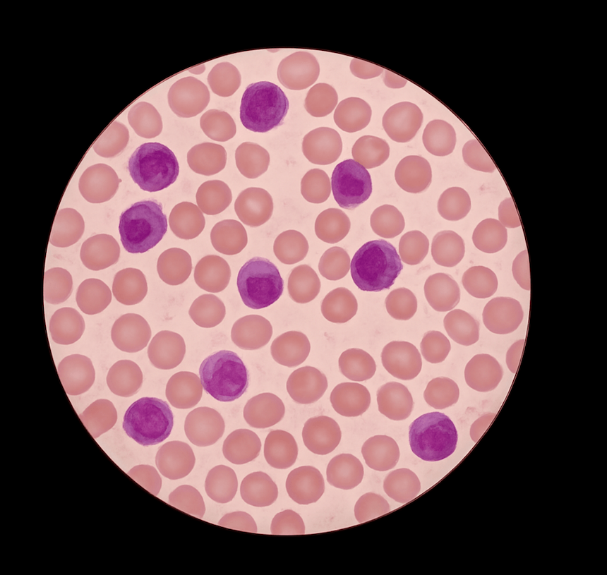 Blood film microscopy abrormal blood cells
