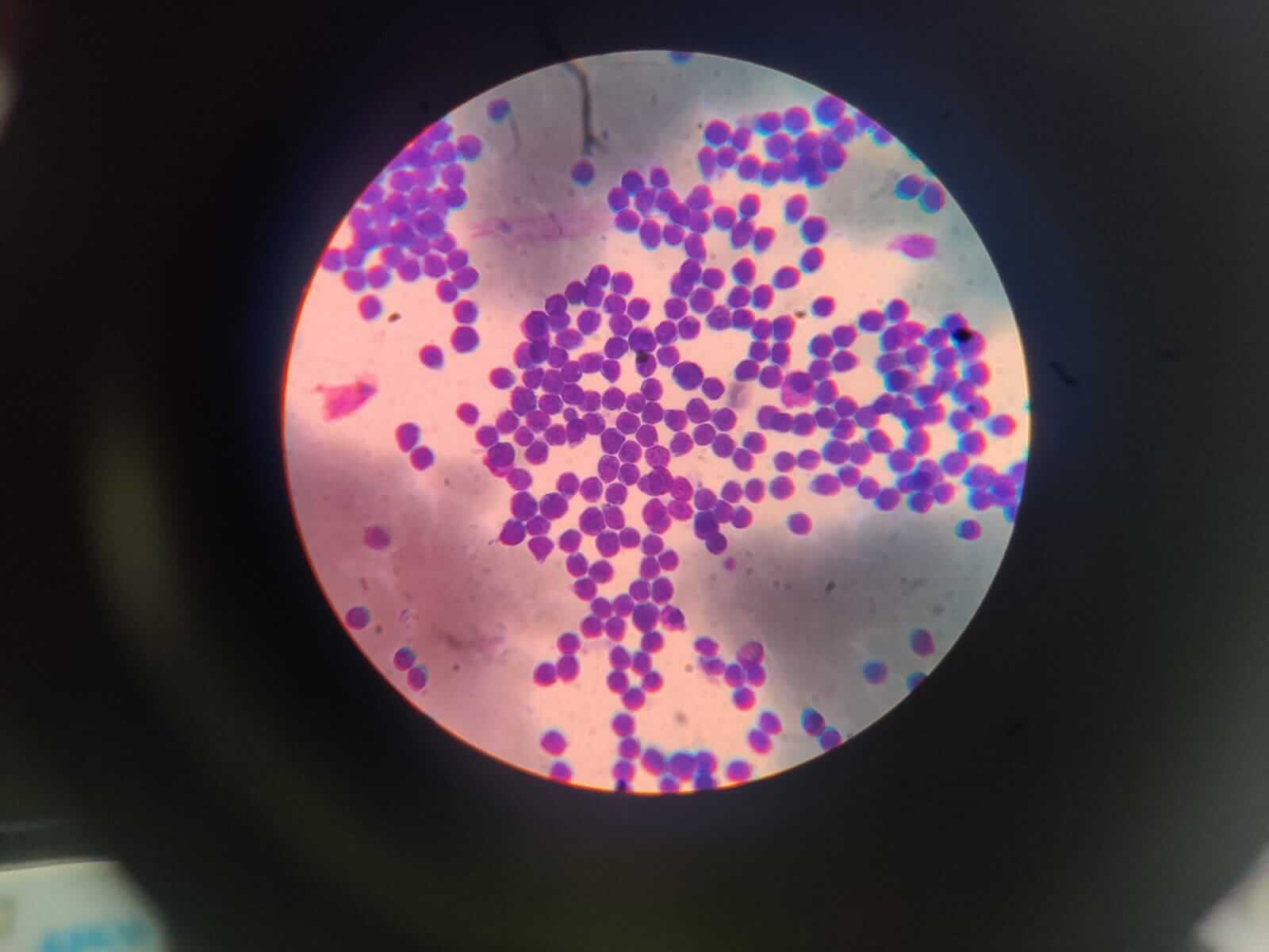 Myeloblasts (immature white blood cells) seen on blood film microscopy, a finding associated with acute leukemia