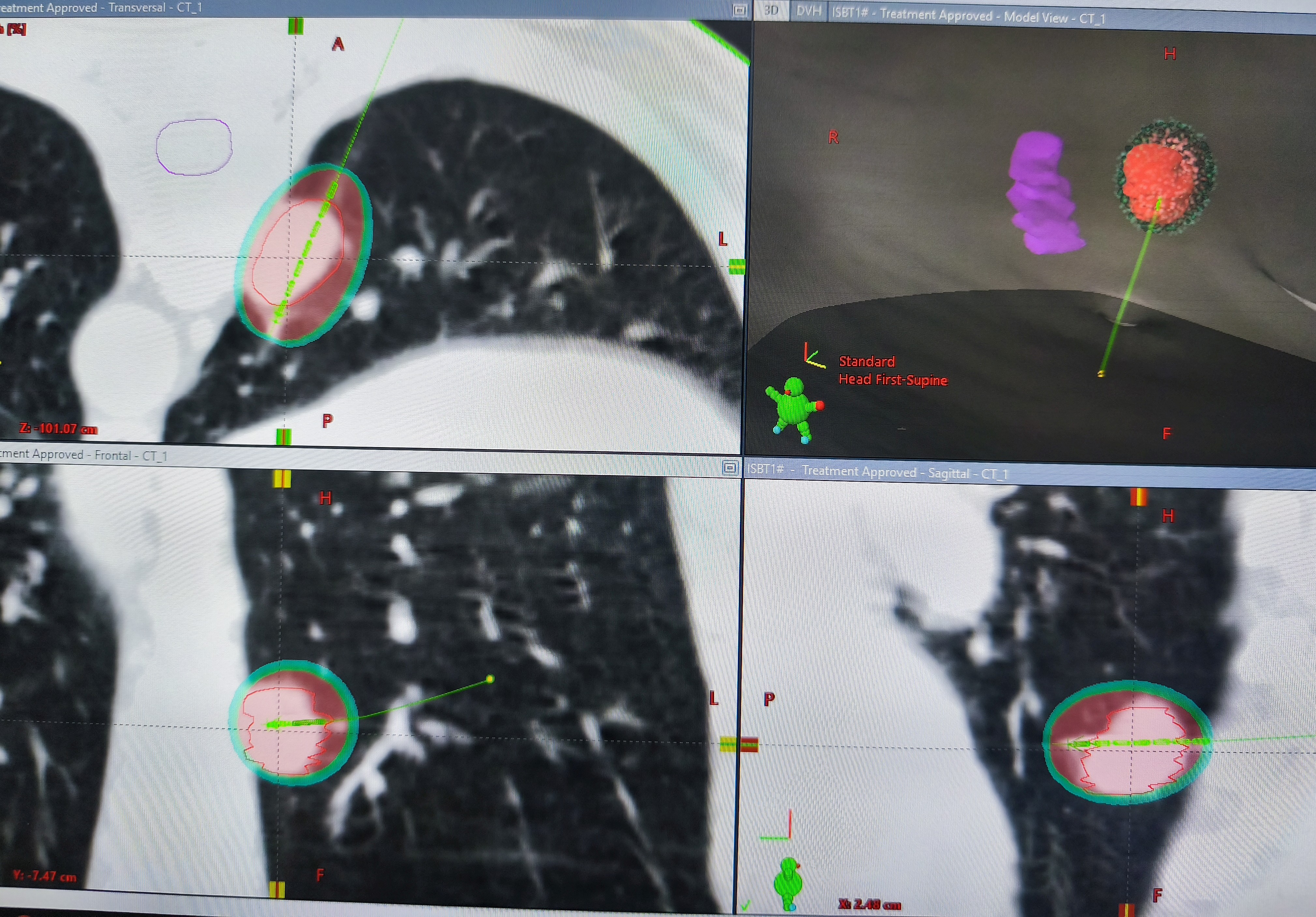 CT-guided brachy-ablation of a lung tumour at Kathmandu Cancer Center