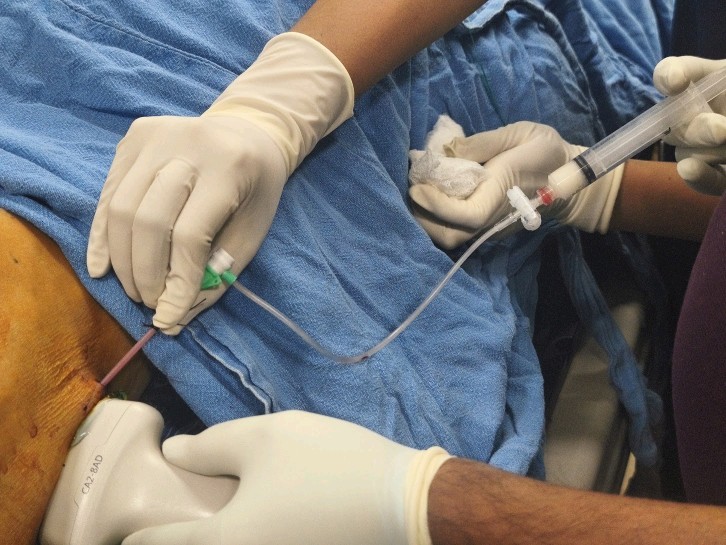 The interventional radiology team at Kathmandu Cancer Center during a procedure