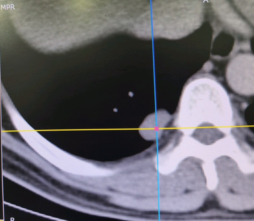 CT-guided biopsy being performed by the interventional radiology team at Kathmandu Cancer Center
